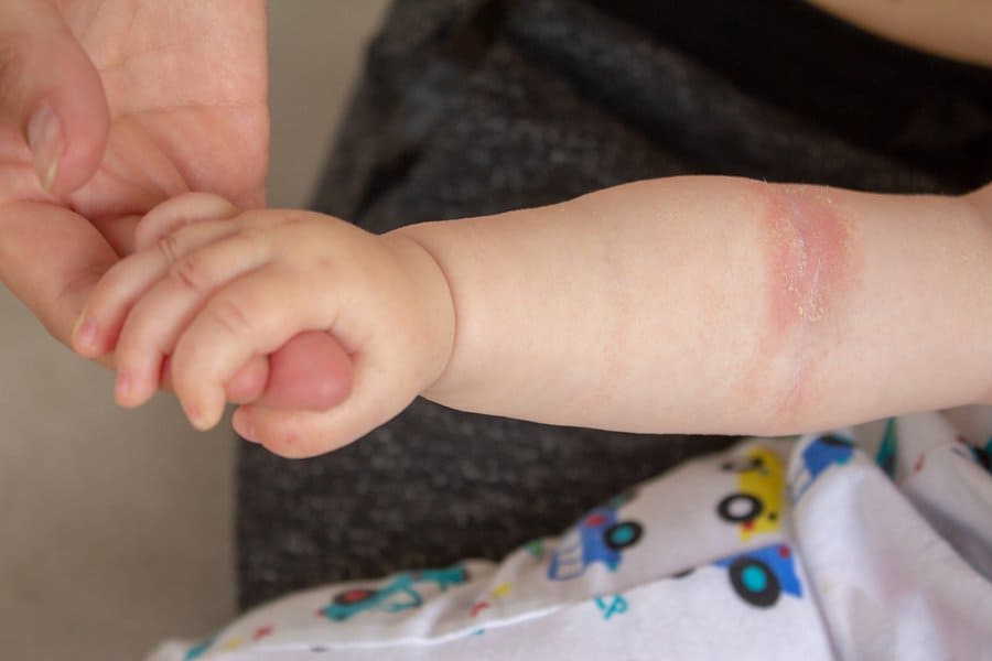 Best Products for Baby's Dry Skin According to Parents